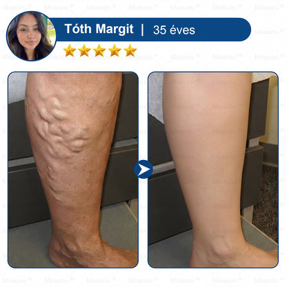 🇭🇺👨‍⚕️✅Moauou® GHK-Cu™ Mikrotűs Regeneráló Tapasz – ⚡kevesebb duzzanat, könnyebb lábak, kevésbé látható erek már 7–14 nap alatt