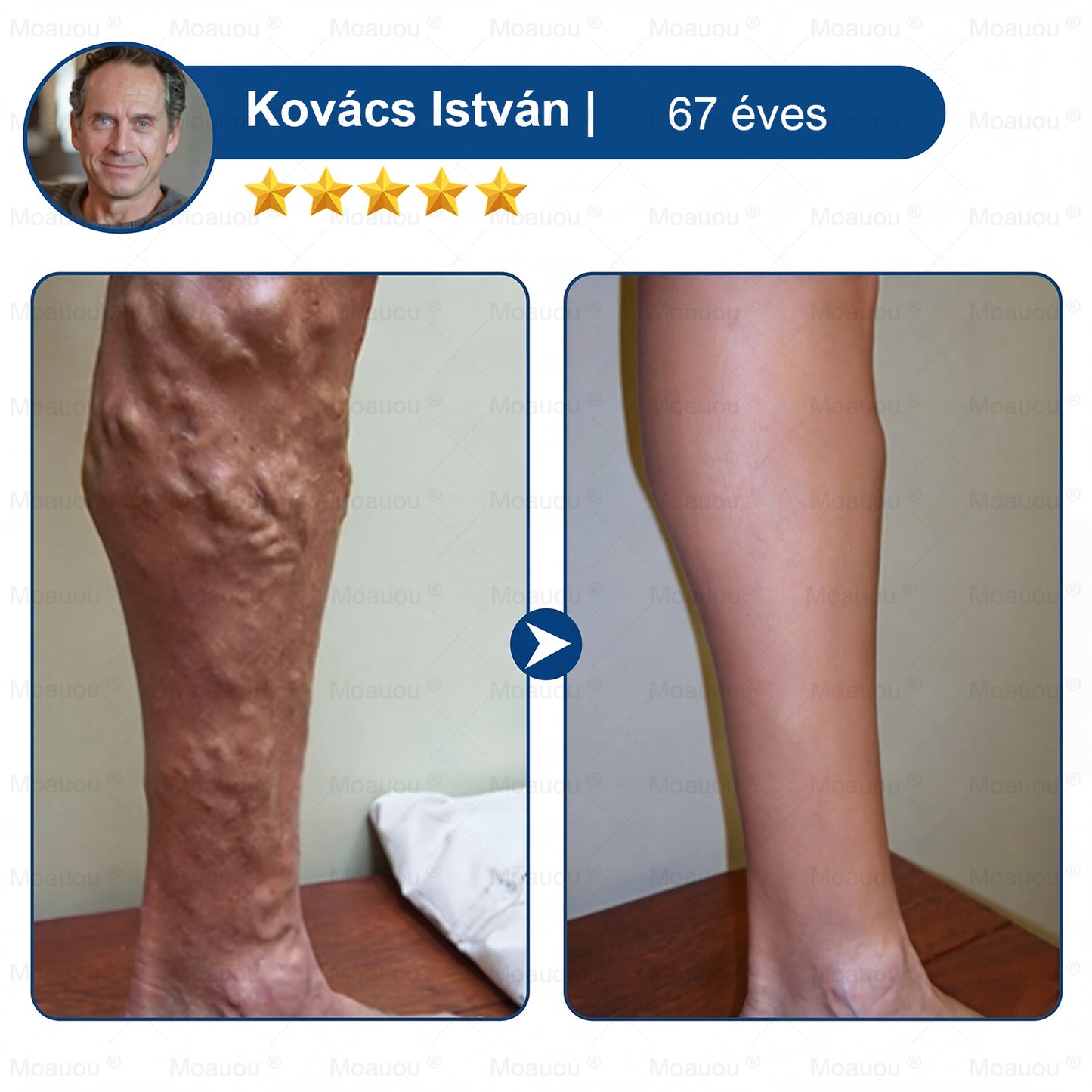 🇭🇺👨‍⚕️✅Moauou® GHK-Cu™ Mikrotűs Regeneráló Tapasz – ⚡kevesebb duzzanat, könnyebb lábak, kevésbé látható erek már 7–14 nap alatt