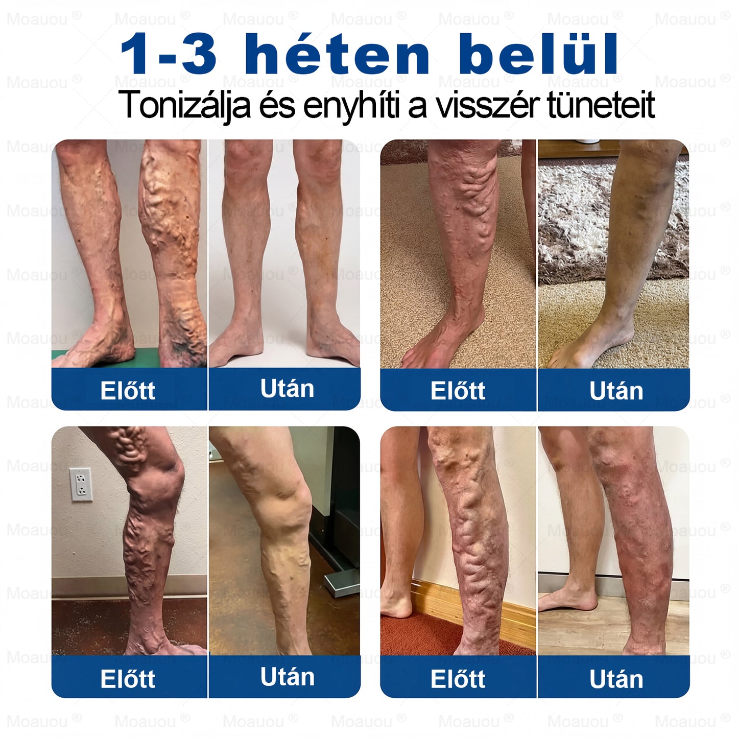 🇭🇺👨‍⚕️✅Moauou® GHK-Cu™ Mikrotűs Regeneráló Tapasz – ⚡kevesebb duzzanat, könnyebb lábak, kevésbé látható erek már 7–14 nap alatt